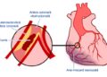 Despre infarctul miocardic