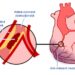 Despre infarctul miocardic
